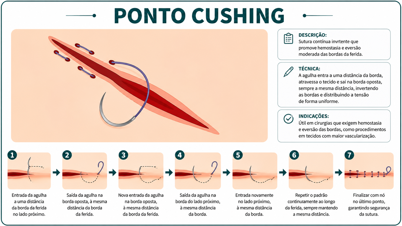 Ilustração da técnica Ponto Cushing