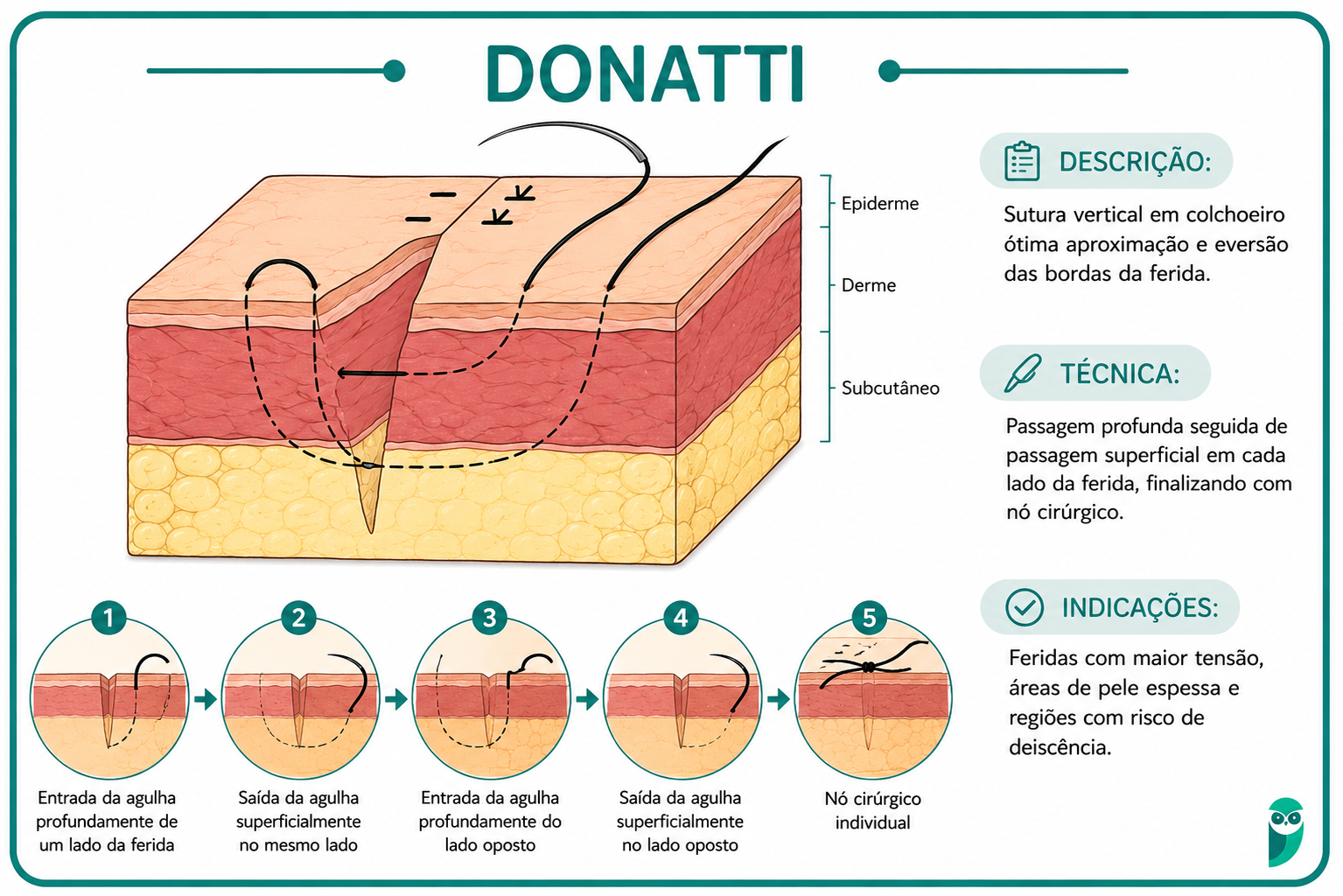 Ilustração da técnica Donatti
