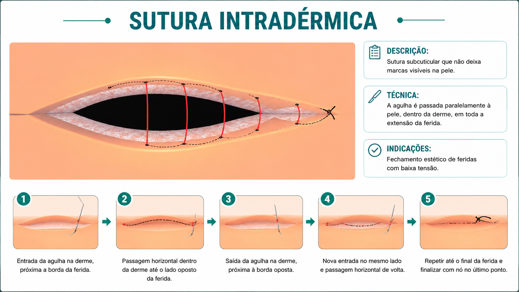 Ilustração da técnica Sutura Intradérmica