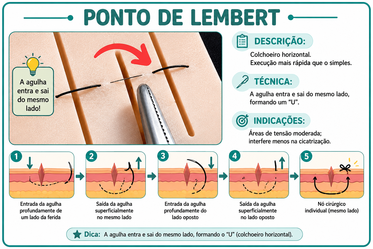 Ilustração da técnica Ponto de Lembert