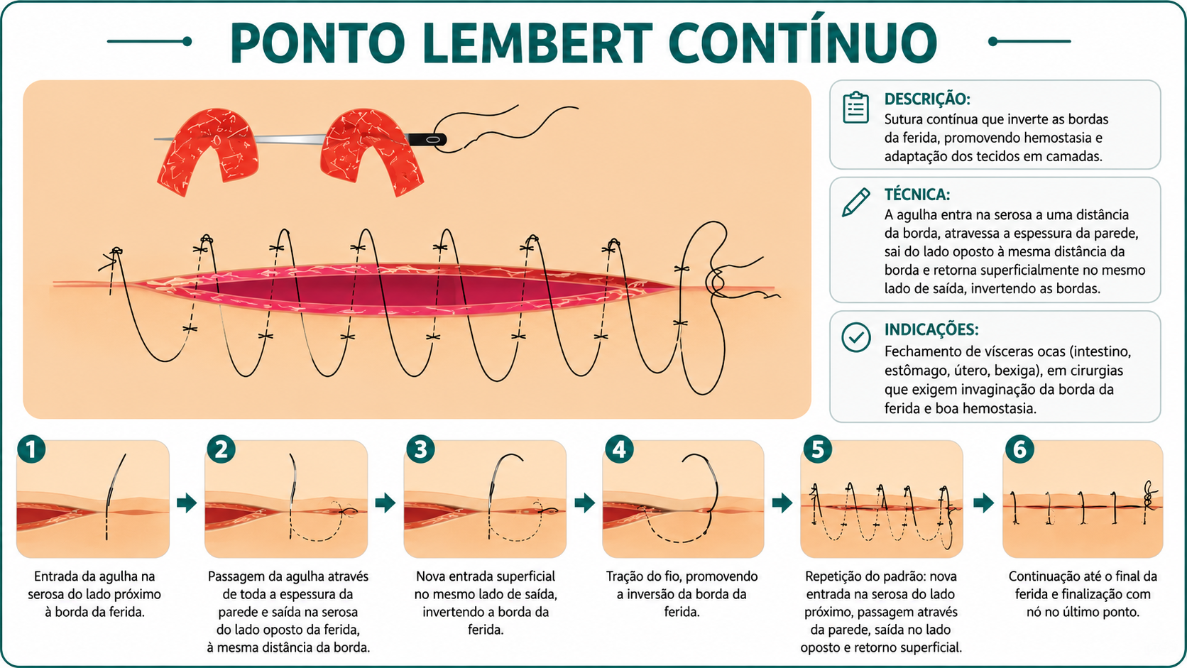 Ilustração da técnica Ponto Lembert Contínuo