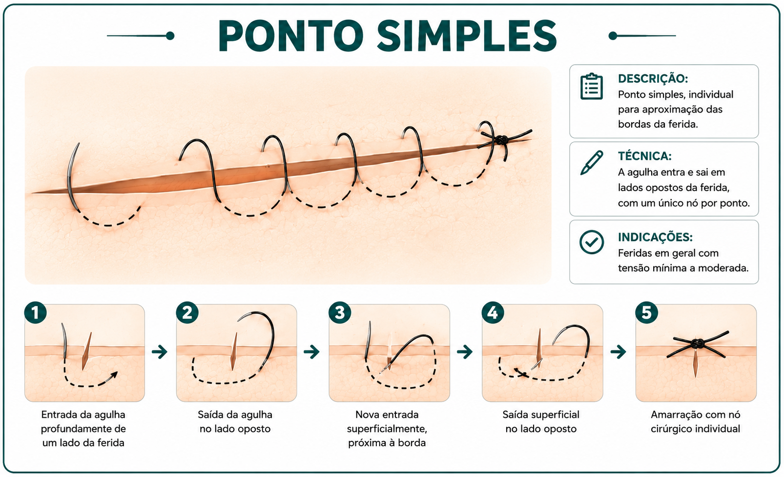 Ilustração da técnica Ponto Simples Contínuo (Chuleio)
