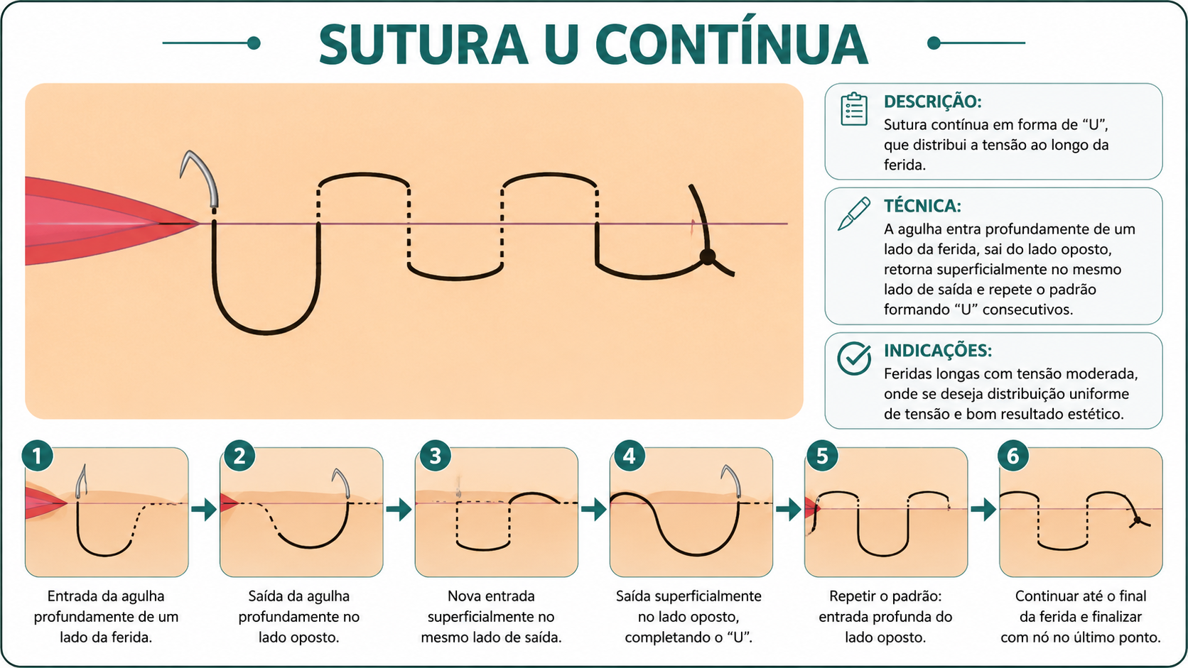 Ilustração da técnica Sutura em U Contínua