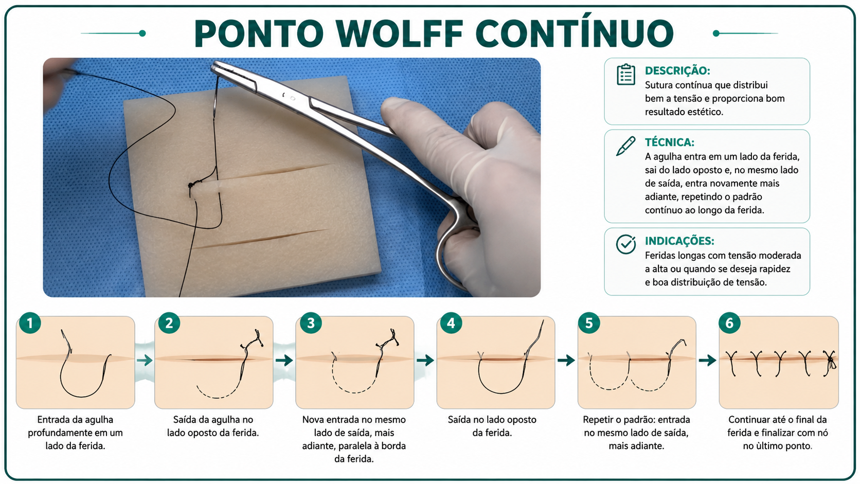 Ilustração da técnica Ponto Wolff Contínuo